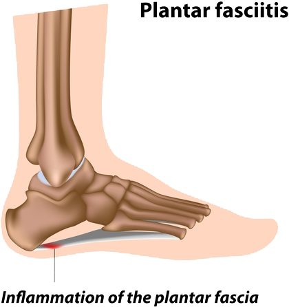 What is Plantar Fasciitis?