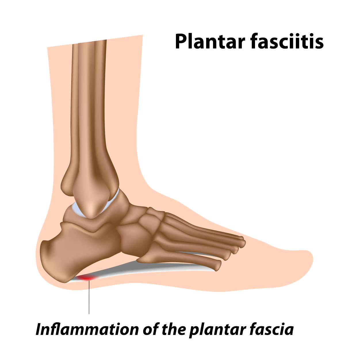 Plantar Fasciitis