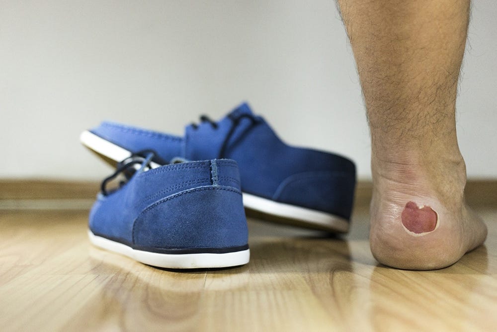 Blisters often form when wearing tight-fitting shoes